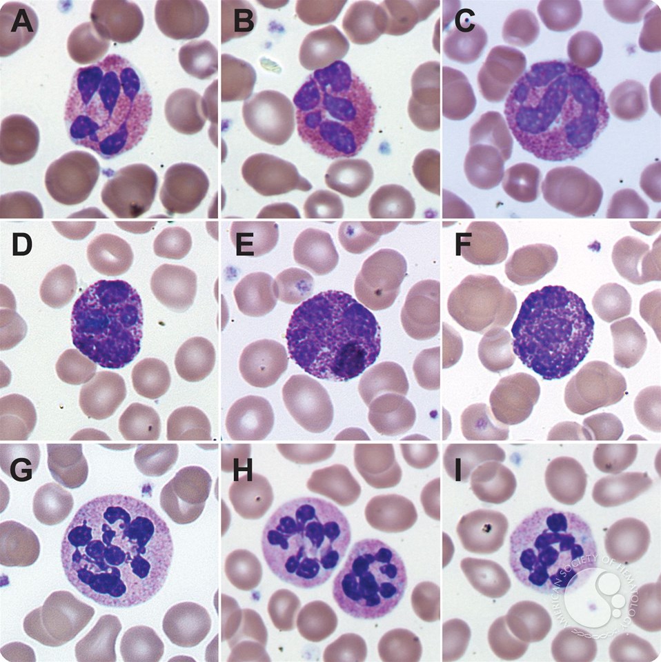 Nuclear hypersegmentation of neutrophils, eosinophils, and basophils due to hydroxycarbamide (hydroxyurea)