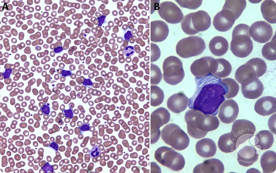 Abnormal lymphocytes with “filamentous-like” cytoplasmic inclusions in chronic lymphocytic leukemia