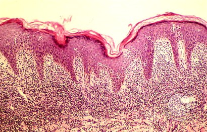 Mycosis Fungoides - 1.