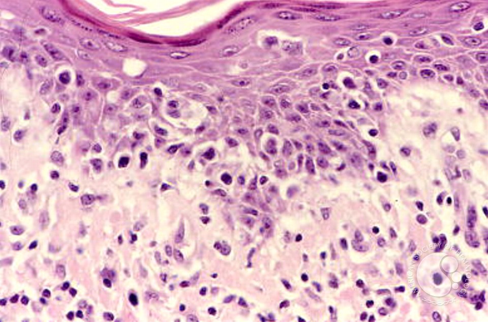 Mycosis Fungoides - 2.