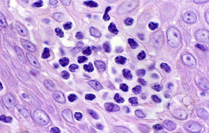 Mycosis Fungoides - 3.