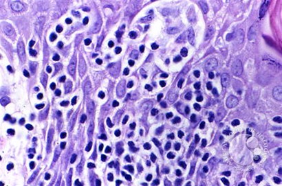 Mycosis Fungoides - 4.