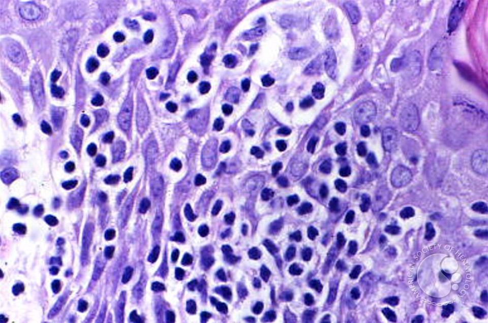 Mycosis Fungoides - 4.