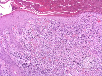 Primary Cutaneous Anaplastic Large Cell Lymphoma - 1.