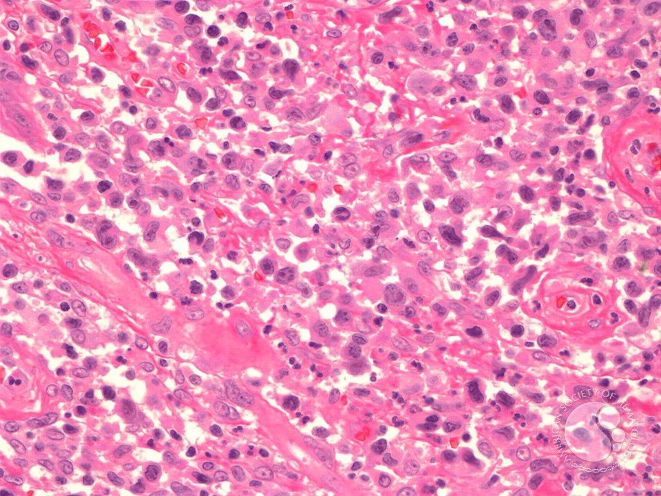 Primary Cutaneous Anaplastic Large Cell Lymphoma - 2.