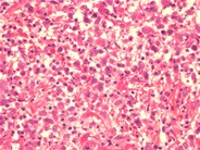 Primary Cutaneous Anaplastic Large Cell Lymphoma 3