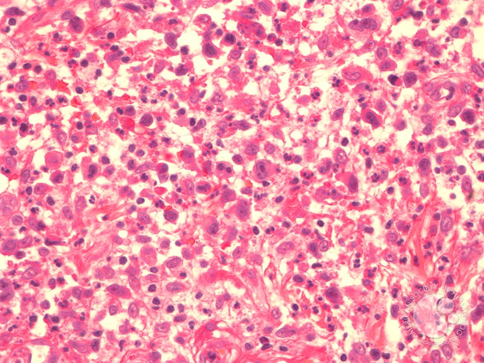Primary Cutaneous Anaplastic Large Cell Lymphoma - 3.