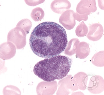 Giant Metamyelocyte - 1.