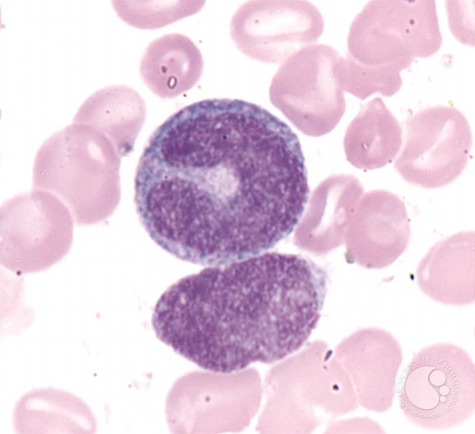 Giant Metamyelocyte - 1.