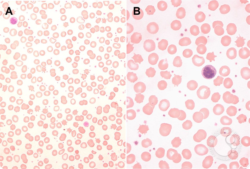 Functional hyposplenism diagnosed by blood film examination