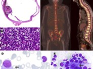 Uveal melanoma with diffuse bone marrow involvement