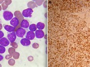 Diffuse large B-cell lymphoma in leukemic phase with flower cell morphology