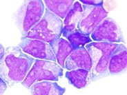 CNS Acute Myeloid Leukemia - 5.
