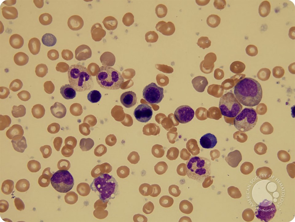 Parvovirus infection mimicking a myeloproliferative neoplasm in a toddler with sickle cell disease