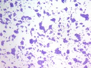 Pleural Fluid Mast Cells - 1.