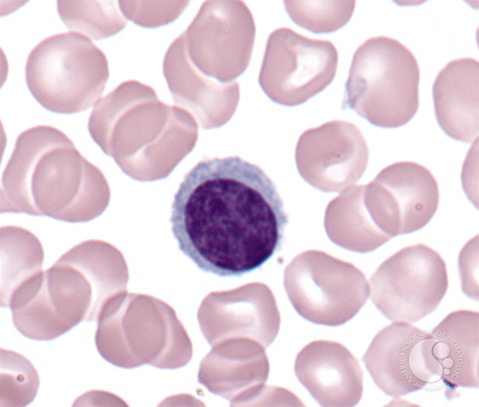 Plasmacytoid Lymphocyte - 1.