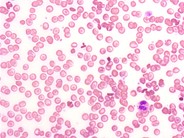 Homozygous Hemoglobin C Disease - 1.