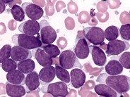 Precursor B-Lymphoblastic Leukemia - 1.