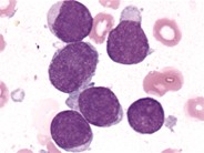 Precursor B-Lymphoblastic Leukemia - 2.