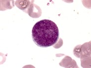 Acute Megakaryoblastic Leukemia - 1.