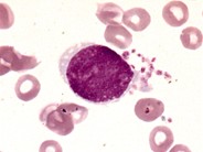 Acute Megakaryoblastic Leukemia - 3.