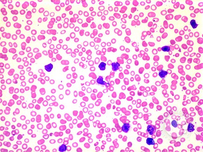 Adult T-cell Leukemia/Lymphoma - 1.