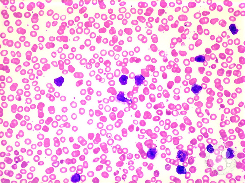 Adult T-cell Leukemia/Lymphoma - 1.