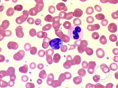 Adult T-cell Leukemia/Lymphoma - 2.