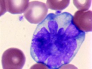 Adult T-cell Leukemia/Lymphoma - 3.