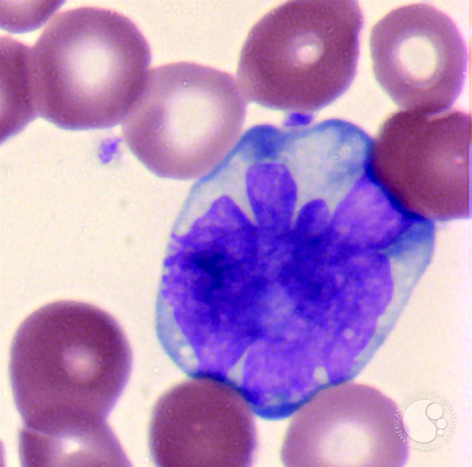 Adult T-cell Leukemia/Lymphoma - 3.