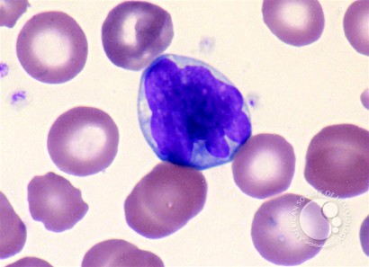 Adult T-cell Leukemia/Lymphoma - 4.