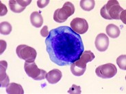 Adult T-cell Leukemia/Lymphoma - 5.