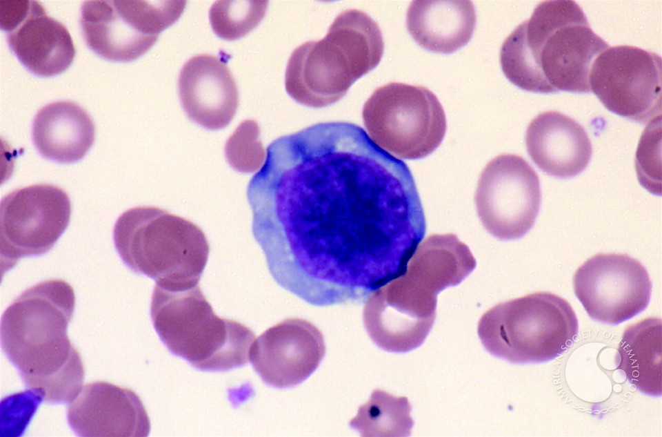 Adult T-cell Leukemia/Lymphoma - 5.