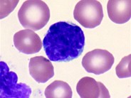 Adult T-cell Leukemia/Lymphoma - 6.