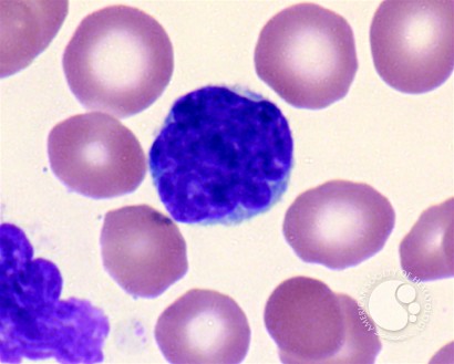 Adult T-cell Leukemia/Lymphoma - 6.