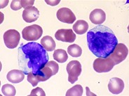 Adult T-cell Leukemia/Lymphoma - 7.