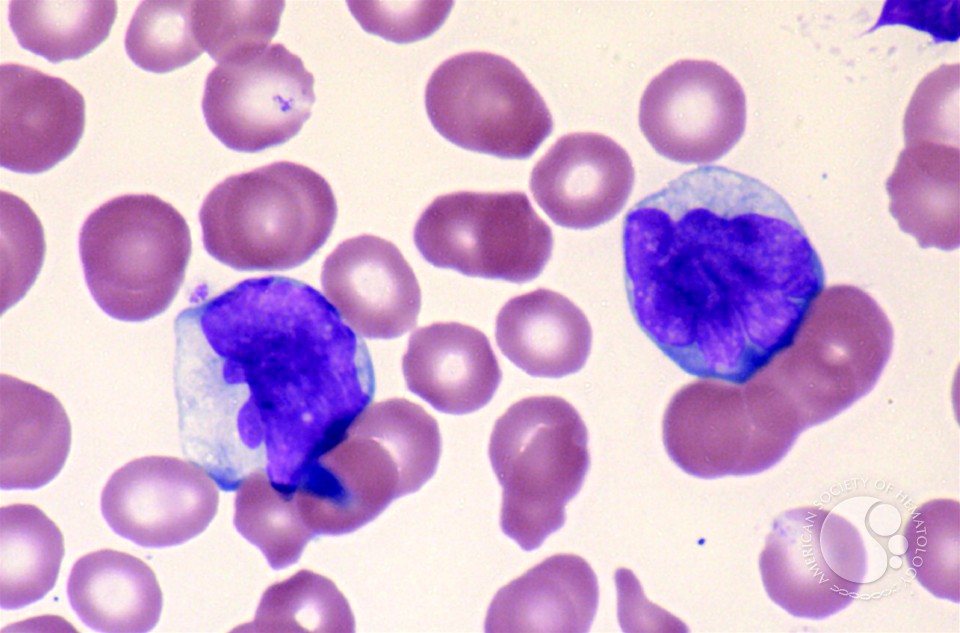 Adult T-cell Leukemia/Lymphoma - 7.