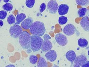 Acute Monoblastic and Monocytic Leukemia - 4.