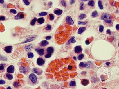 Hemophagocytosis: Bone Marrow Biopsy of Patient With Hepatitis C and Acute EBV Infection - 1.