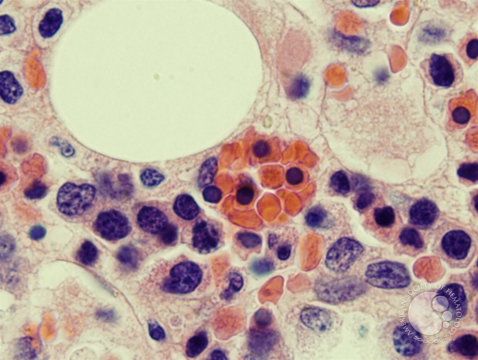 Hemophagocytosis: Bone Marrow Biopsy of Patient With Hepatitis C and Acute EBV Infection - 2.