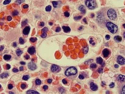 Hemophagocytosis: Bone Marrow Biopsy of Patient With Hepatitis C and Acute EBV Infection - 3.