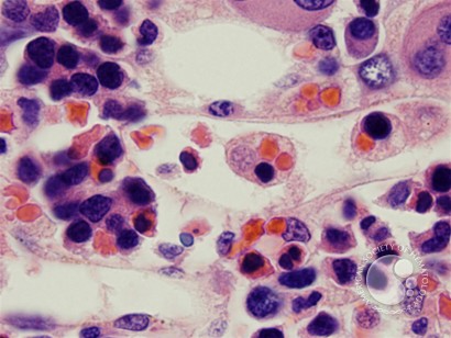 Hemophagocytosis: Bone Marrow Biopsy of Patient With Hepatitis C and Acute EBV Infection - 4.
