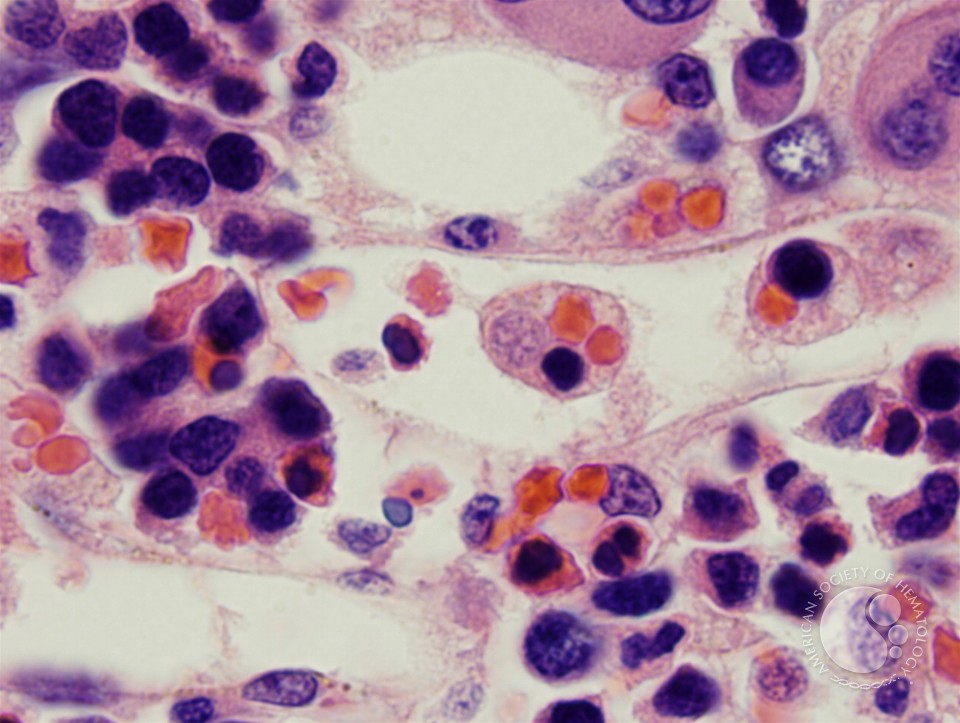 Hemophagocytosis: Bone Marrow Biopsy of Patient With Hepatitis C and Acute EBV Infection - 4.