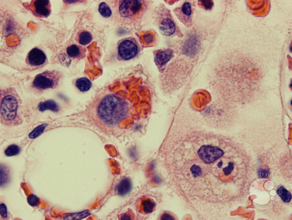 Hemophagocytosis: Bone Marrow Biopsy of Patient With Hepatitis C and Acute EBV Infection - 5.