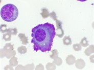 Flame Cells in Multiple Myeloma - 1.