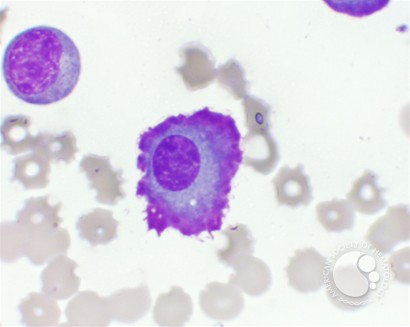 Flame Cells in Multiple Myeloma - 1.