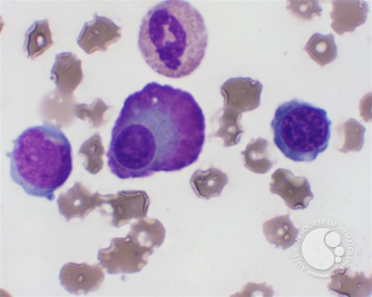 Flame Cells in Multiple Myeloma - 2.