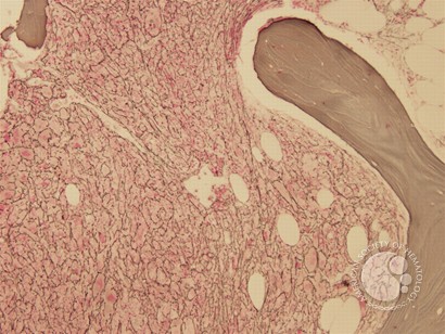 Myelofibrosis and Megakaryocyte Clustering - 1.