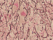 Myelofibrosis and Megakaryocyte Clustering - 2.