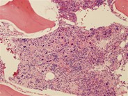 Myelofibrosis and Megakaryocyte Clustering - 3.